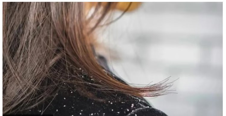 Excessive dandruff and scalp issues are the odd companions of anxiety and stress.