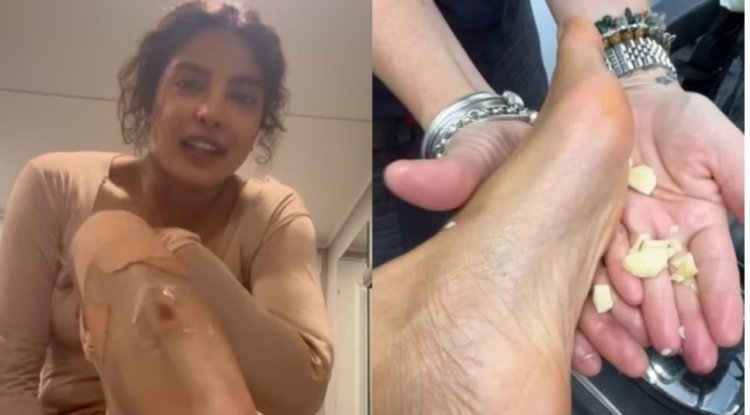 After being hurt while filming an Australian movie, Priyanka Chopra attempts the Indian "nuskha" of applying garlic on her feet.